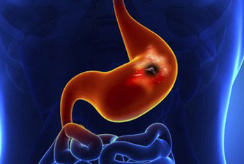 胃癌5大发病因素