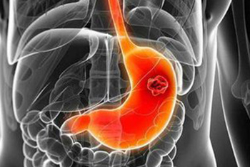 胃癌肝转移有哪些症状?