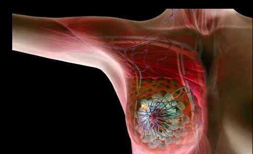<b>乳腺癌转移有什么预兆?</b>