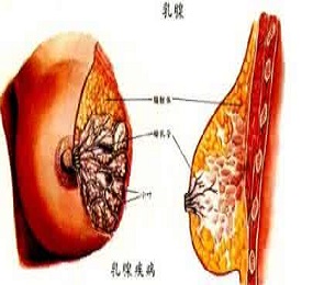 乳腺结节百科