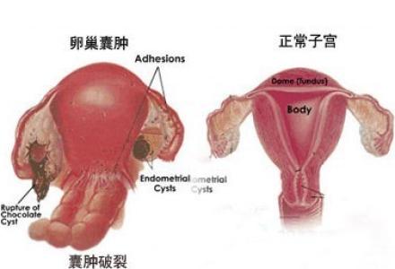 <b>子宫肌瘤多大需要手术?</b>